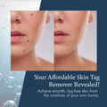 SkinPro Skin Tag Corrector