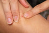 How You Should Treat A Bleeding Skin Tag